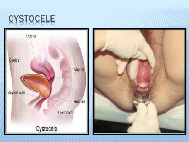 bulge from vagina Bulge from vagina